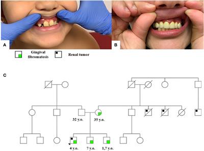 Case Report: Two clinical cases of Wilms tumor comorbid to gingival fibromatosis in young children with constitutionally mutated REST